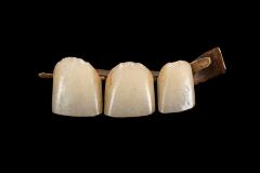 Bridge Work, False Teeth